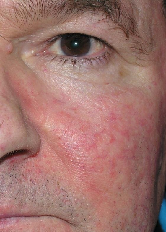 Rosacea After (2)