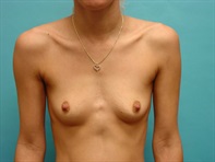 Dr. Serra Surgical Before & After