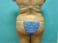 Dr. Serra Surgical Before & After